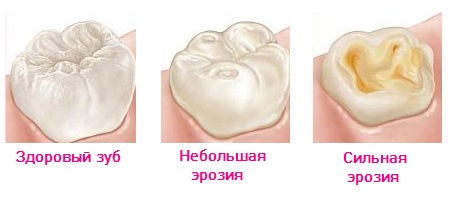 Стадии эрозии эмали