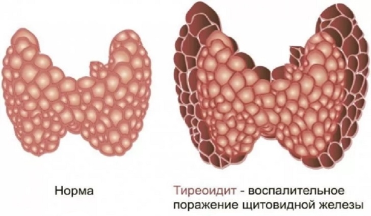 Аутоиммунный тиреоидит