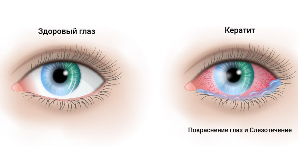 Симптомы кератита