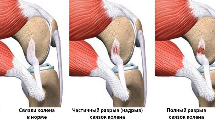 Виды и степени повреждений связок колена
