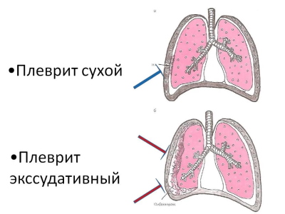Сухой и эссудативный плеврит наглядно Сухой и эссудативный плеврит