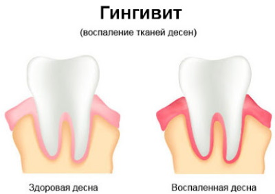 Здоровая десна и воспаленная