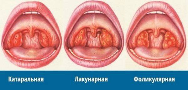 Горло при ангине